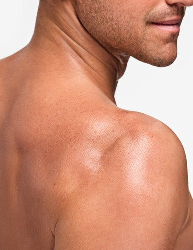 Laser Pigmentation Removal Shoulders
