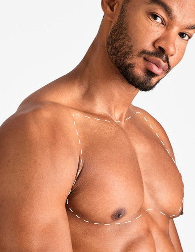 Chest - Laser Hair Removal
