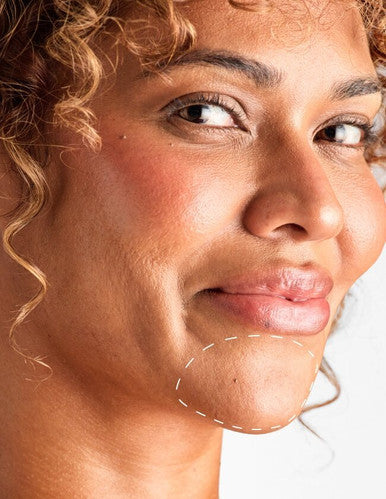 Chin - Laser Hair Removal