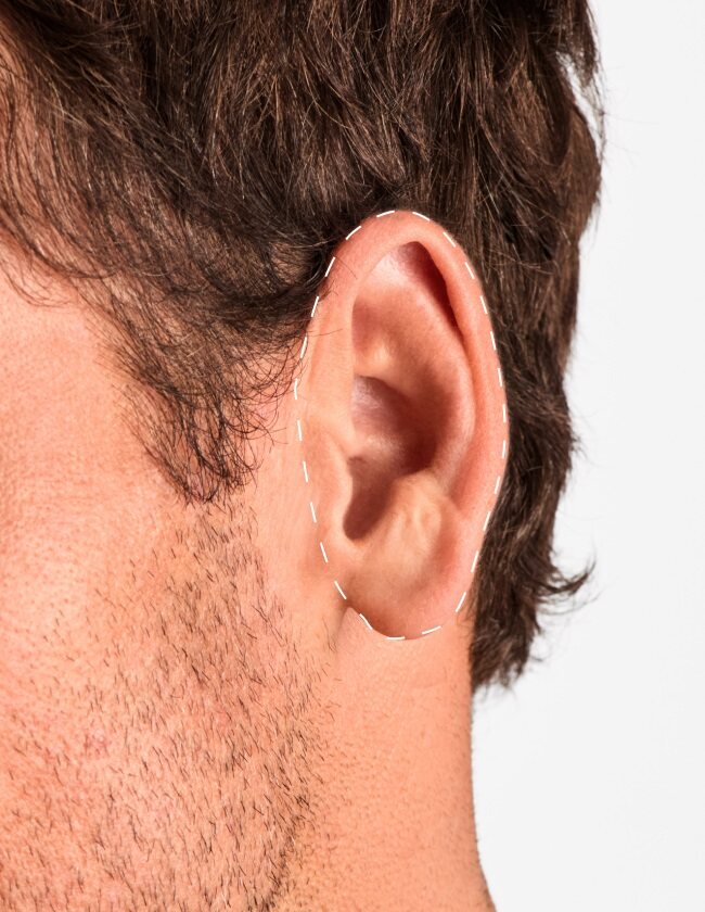 Ears - Laser Hair Removal