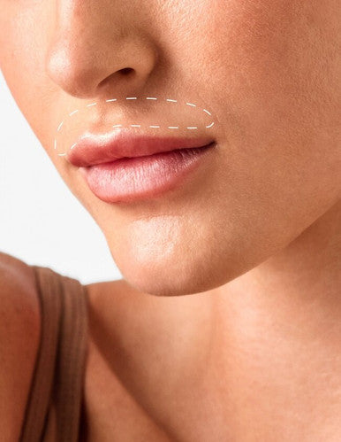 Lip - Laser Hair Removal