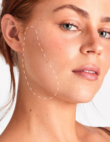 Side Burns - Laser Hair Removal