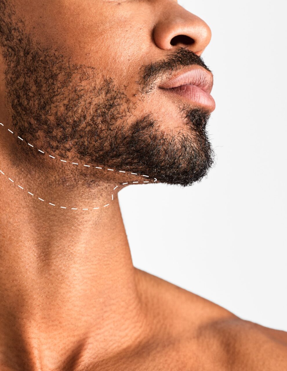 Jawline - Laser Hair Removal