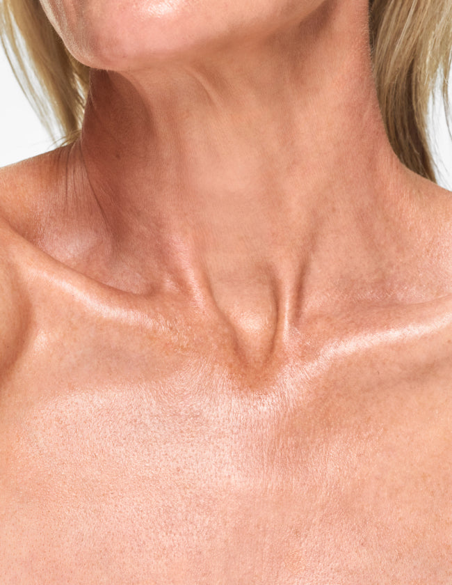 Laser Pigmentation Removal Decolletage