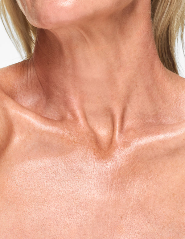 Laser Pigmentation Removal Decolletage