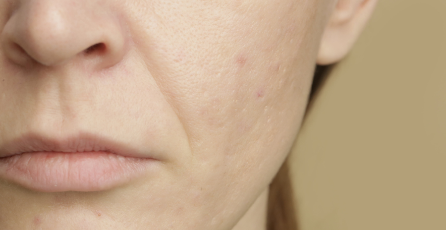 7 Treatments To Shrink Enlarged Pores On The Face